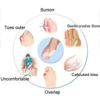 Bunion Corrector Silicone Toe Sleeves and Separator - Yahko Merchandise