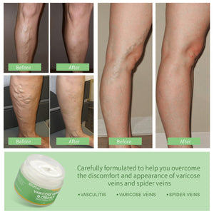 Vein Cream Red Blood Streaks Repair Earthworm Leg Bruises Bulge Relief Pain Safflower Skin care lotion Varicose Cream - Yahko Merchandise